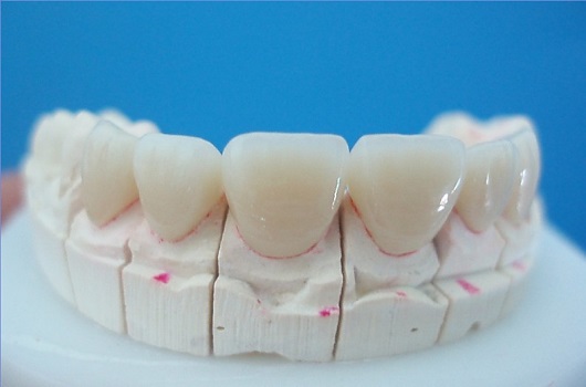 All-Ceramic-CrownBridge