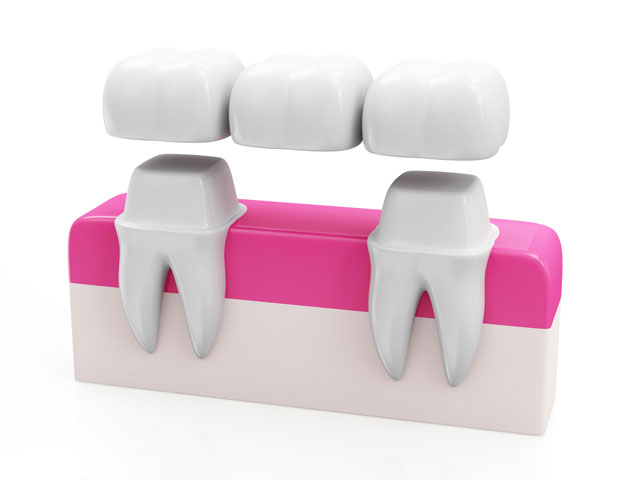 Dental Bridge