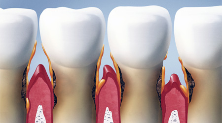 periodontitis