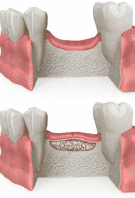 Bone-augmentation