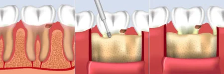 Crown-Lengthening 2