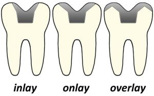 INLAY-ONLAY-OVERLAY