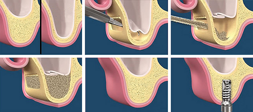 SINUS LIFT