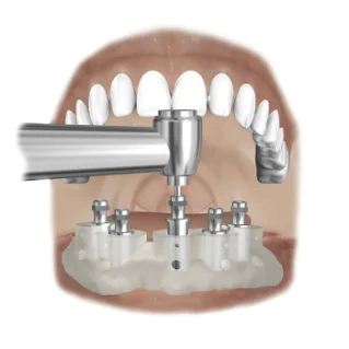 SURGICAL GUIDE SIMPLANT