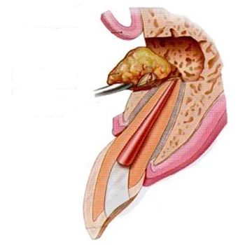apicoectomy-images-temp-2