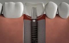 dental-implants 5