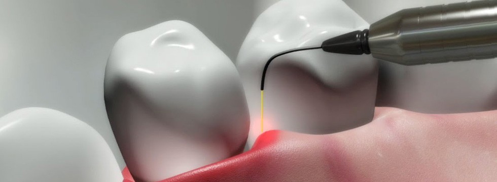 dental-laser-