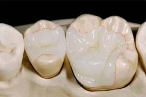 inlay- ONLAY