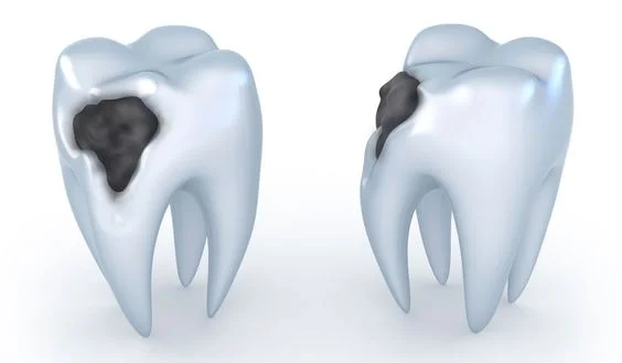 tooth decay