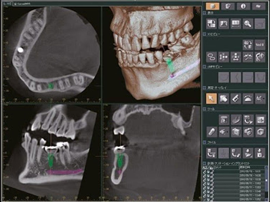 CBCT