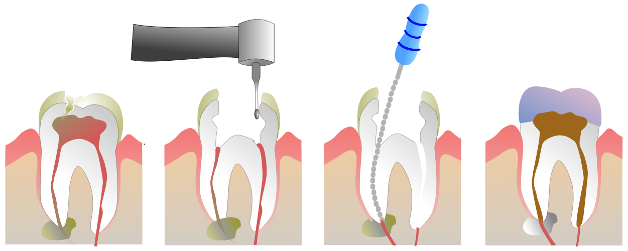 endo12
