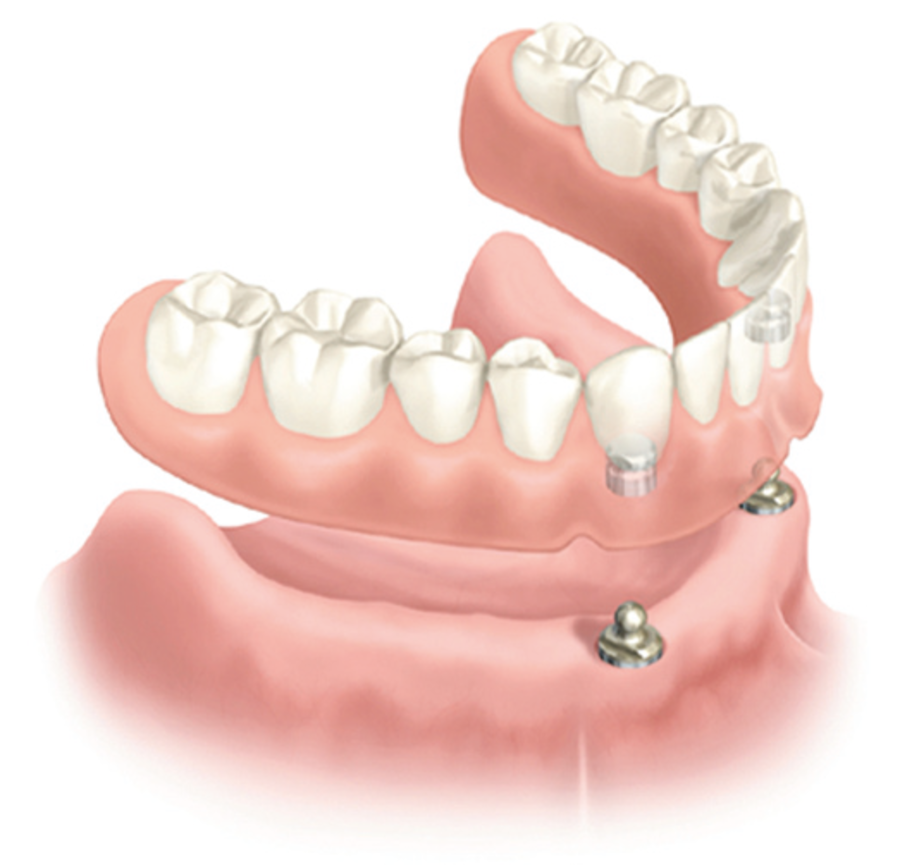 Overdenture with ball